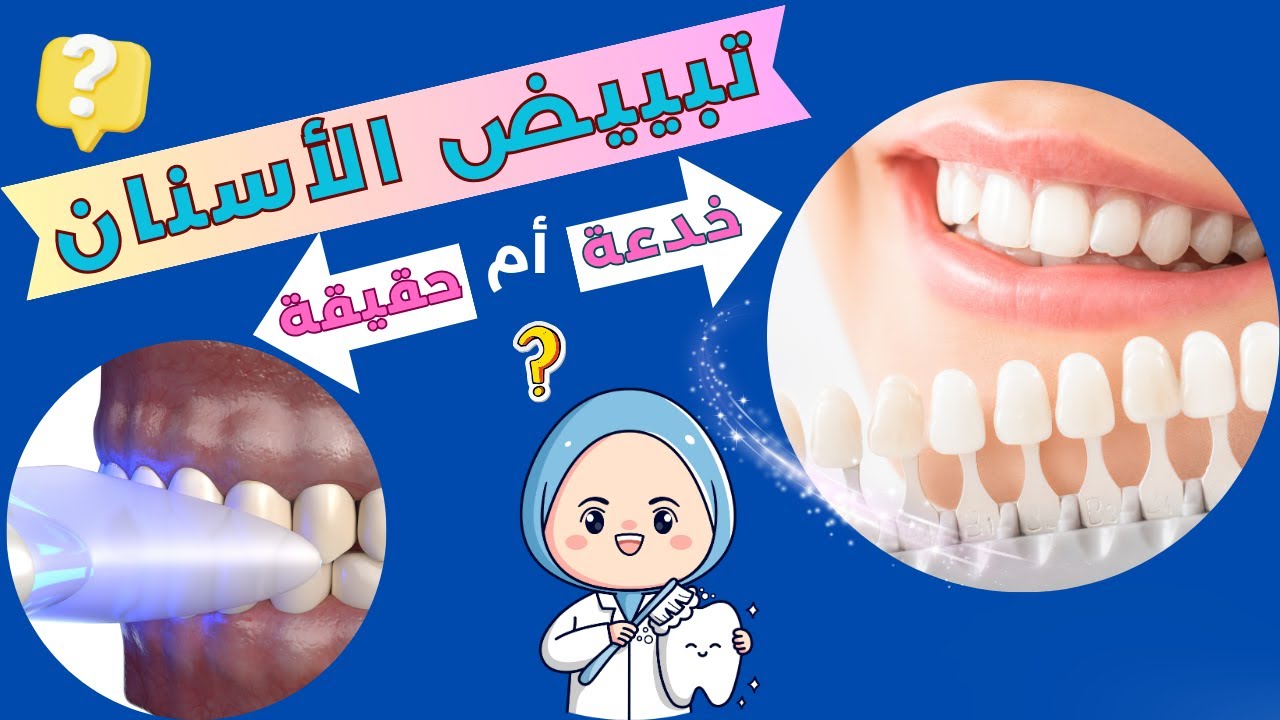 علاج الاسنان | اكتشف الحقيقة الكاملة لتبييض الاسنان!!! | تبييض الاسنان في المنزل |حكاية أسناني.
