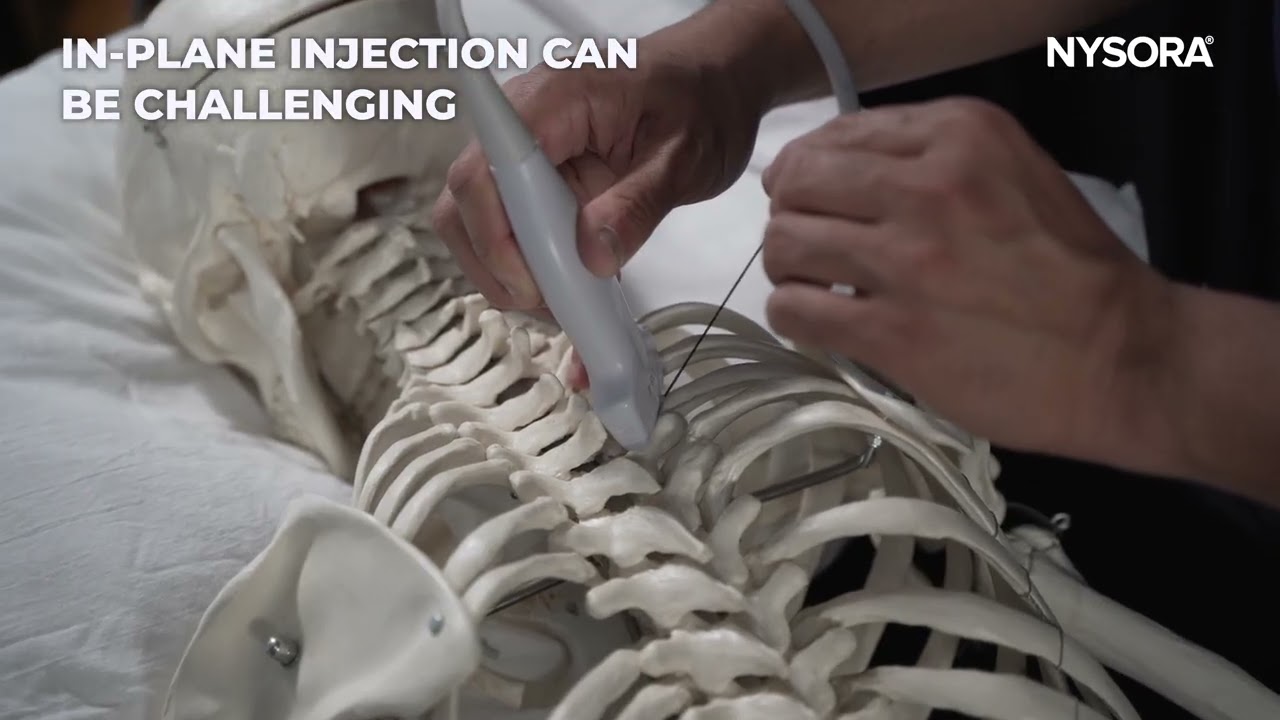 Ultrasound-Guided Costotransverse Joint Injection Medstudylab.com