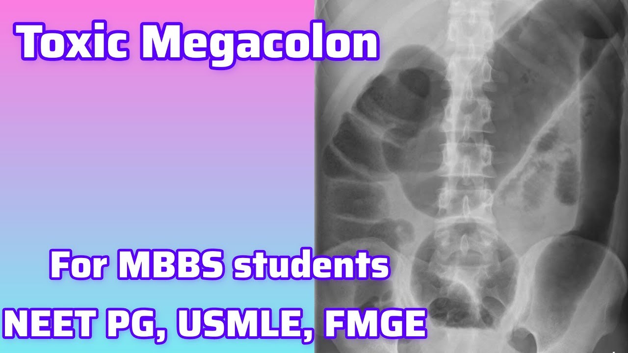 Toxic Megacolon For MBBS students, Neet PG, Usmle, FMGE I Neet PG Usmle Preparation