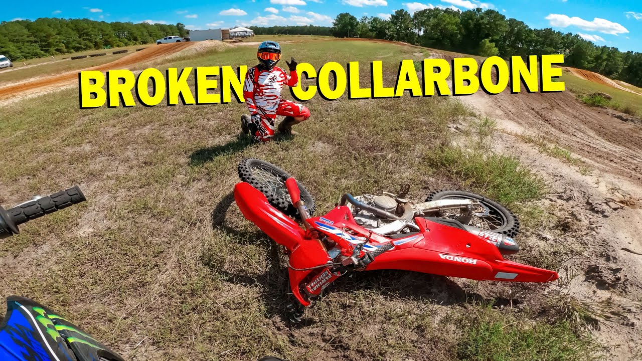 Broken Collarbone at Backyard MX Track