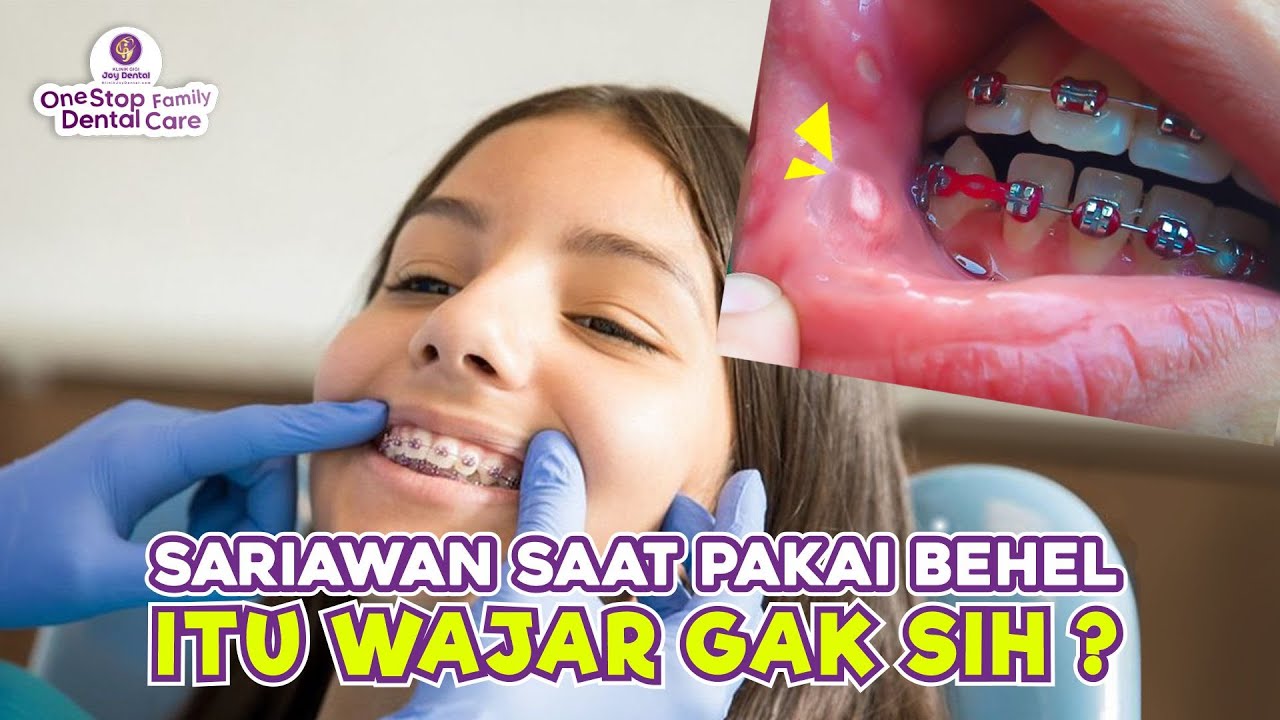 AWAL PAKAI BEHEL TUMBUH SARIAWAN TERUS ? WAJAR GAK SIH ?