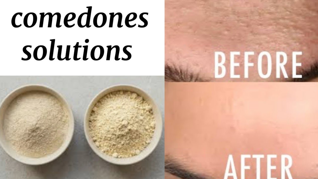 Homemade face mask | closed comedones & acne | in urdu | hindi | 