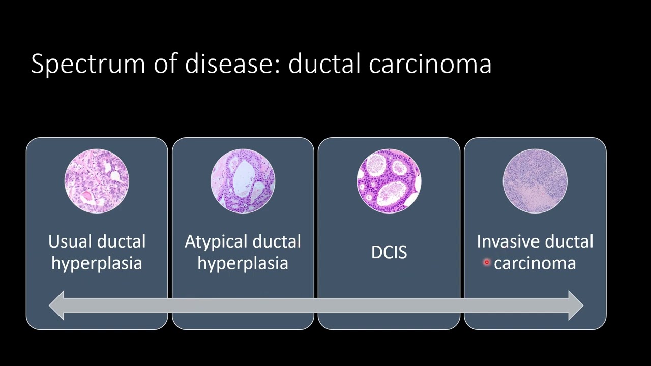 Invasive Ductal Carcinoma