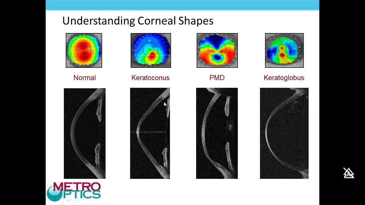 KeraSoft IC Soft Lens for Irregular Cornea Webinar