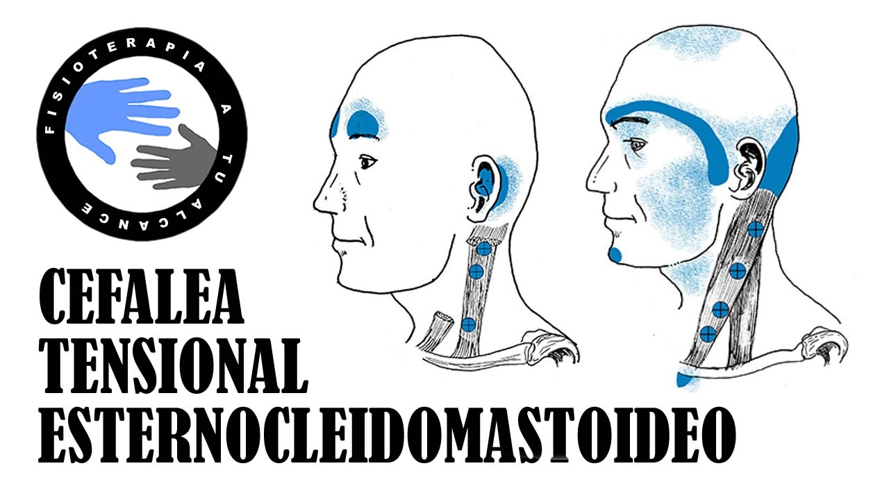 Dolor de cabeza, masaje del musculo esternocleidomastoideo o ECM para la cefalea tensional