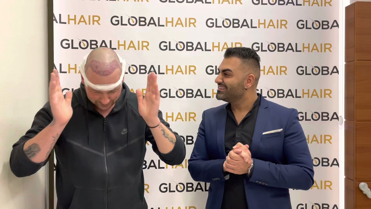Meteen na de haartransplantatie van Ramon de Bakker ( Vlog: De Bakkertjes ) bij GlobalHair