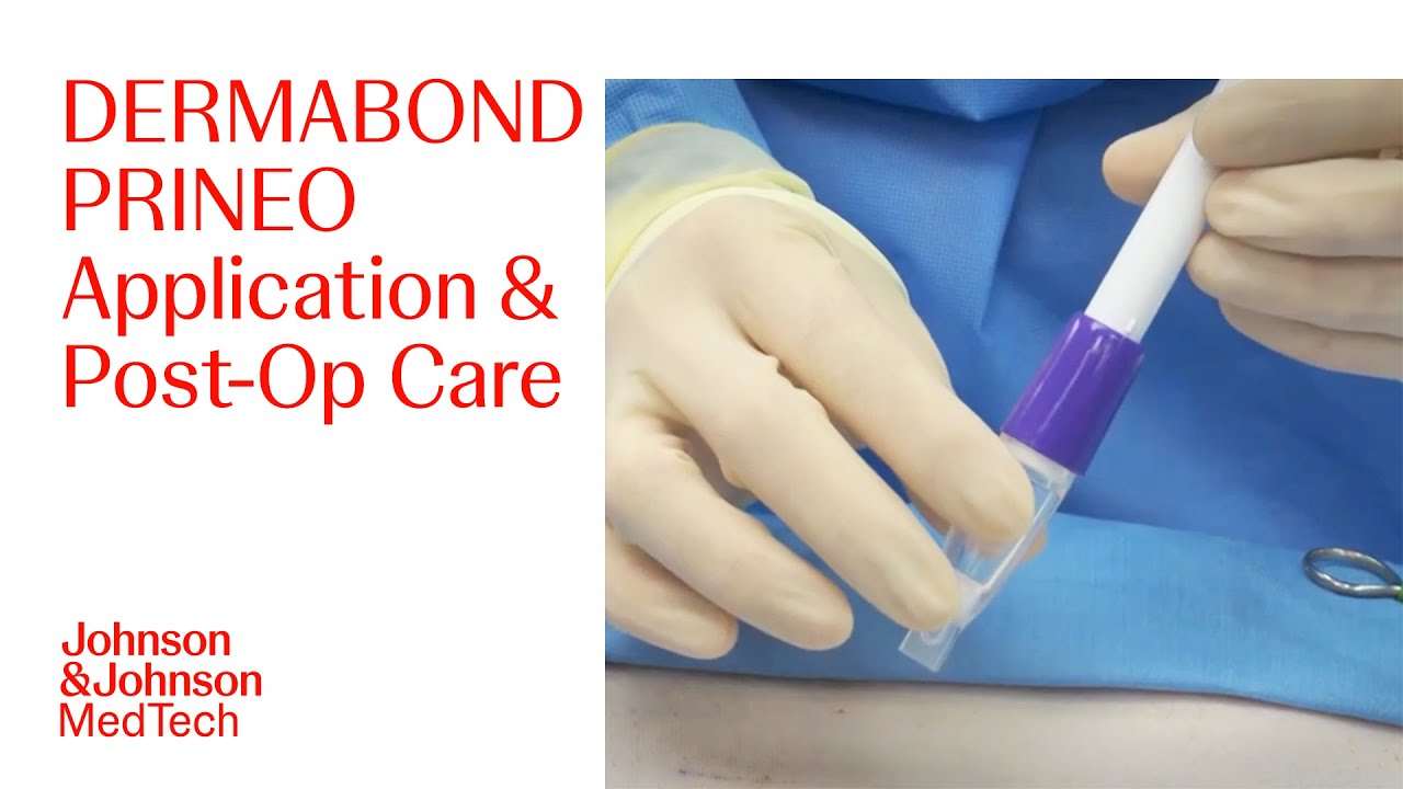 DERMABOND PRINEO Application Technique & Post-Op Care | J&J MedTech