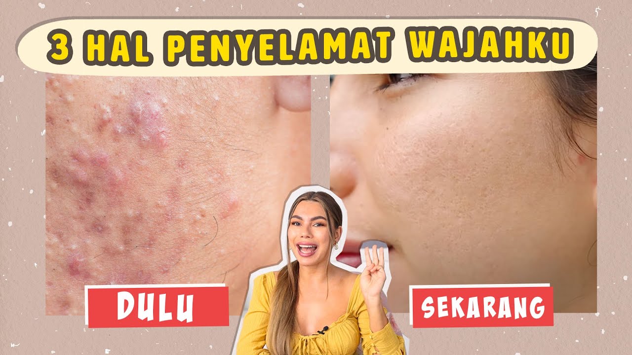 Andai dulu aku tau 3 HAL INI !! Jerawat pasti gak akan balik ⭐️ 🥺