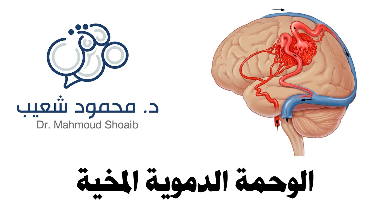 الوحمة الدموية المخية - د. محمود شعيب