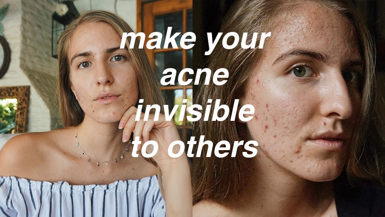 STOP PEOPLE FROM LOOKING AT YOUR ACNE