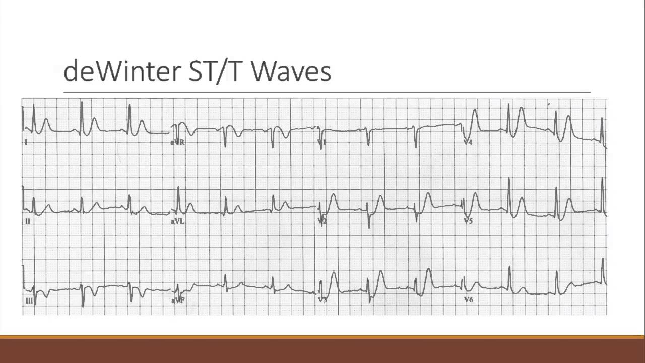 NSTEMIs that need the cath lab now