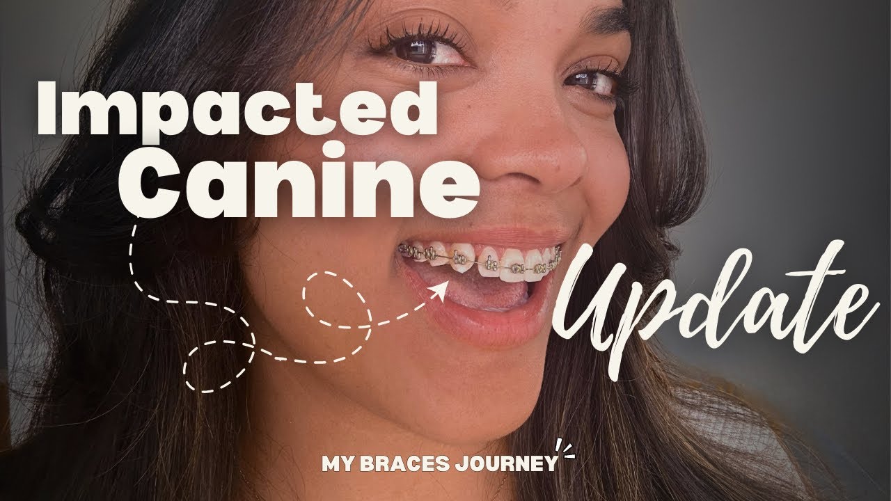 My canine is fully down! I got a bracket on and switched from metal to sapphire braces. Check it out