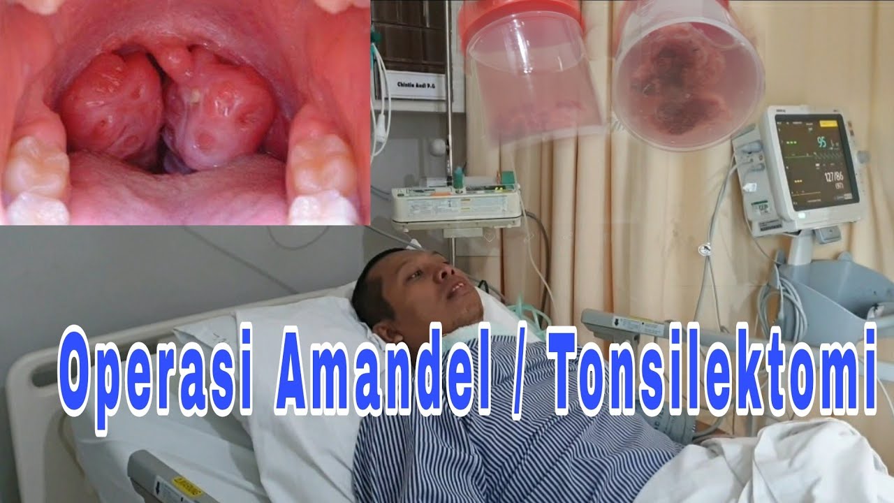 Operasi Amandel/Tonsilektomi