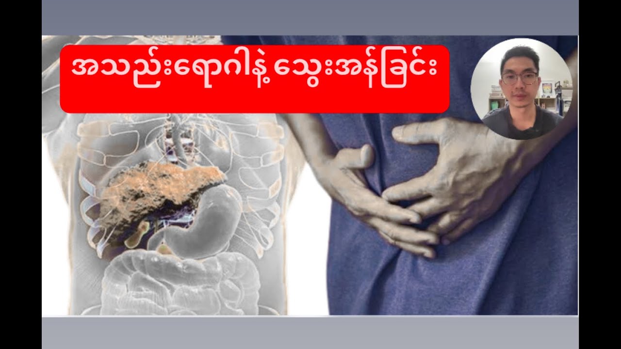 အသည်းရောဂါ နဲ့ သွေးအန်ခြင်း : Liver and Haemetamesis