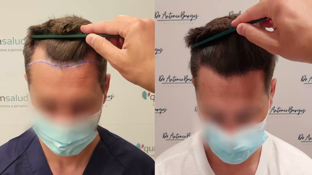 Injerto Capilar FUE - 2141 UFS - DR ANTONIO BURGOS