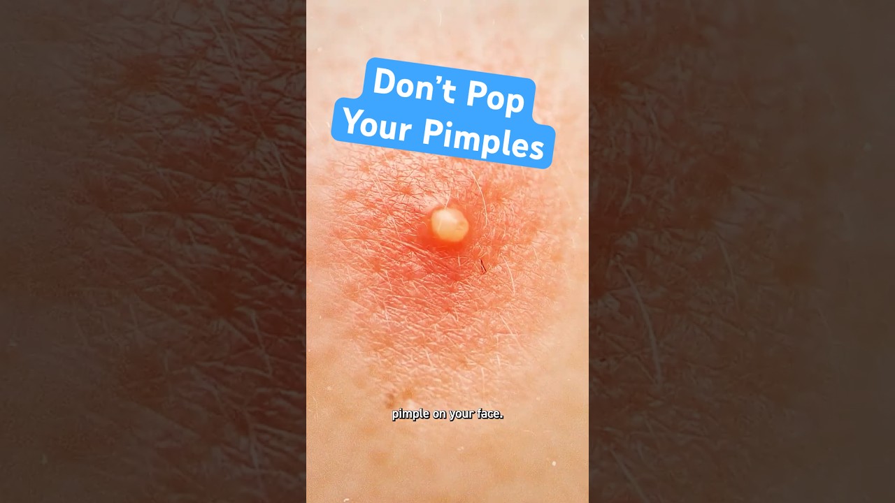 Why Popping Pimples Makes Them Worse
