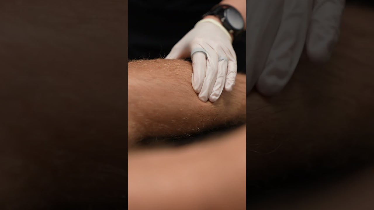 Dry Needling REALLY Tight Calves