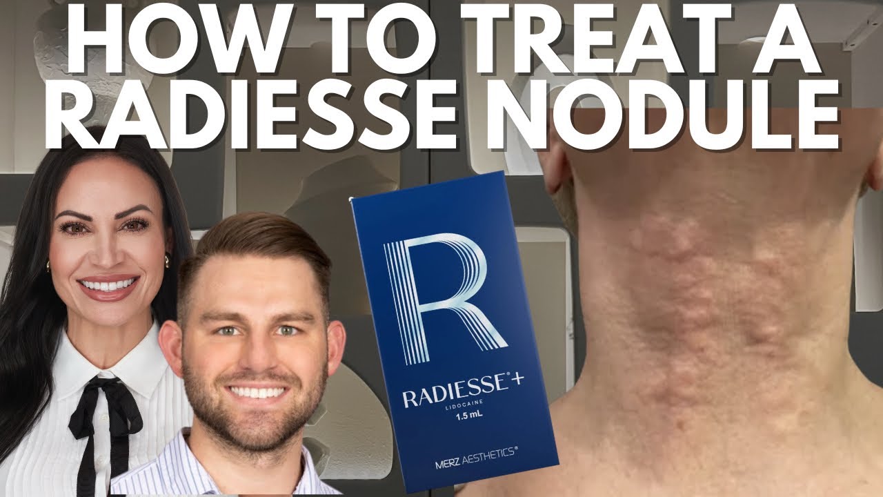 HOW TO TREAT A RADIESSE NODULE