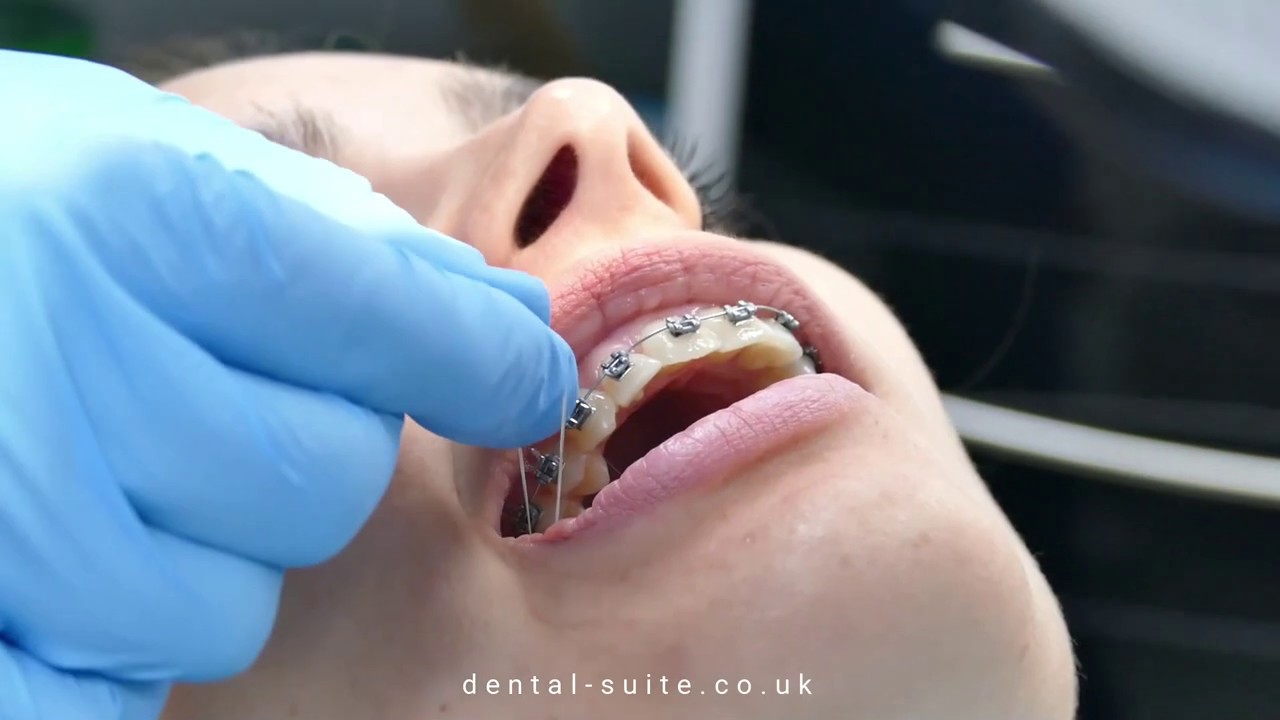 Why are elastics/rubber bands used in brace treatment? Orthodontics explained!