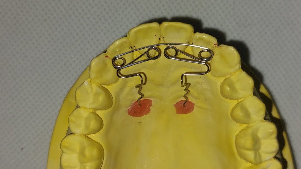 Recurved Z Spring: Orthodontic Wire Bending