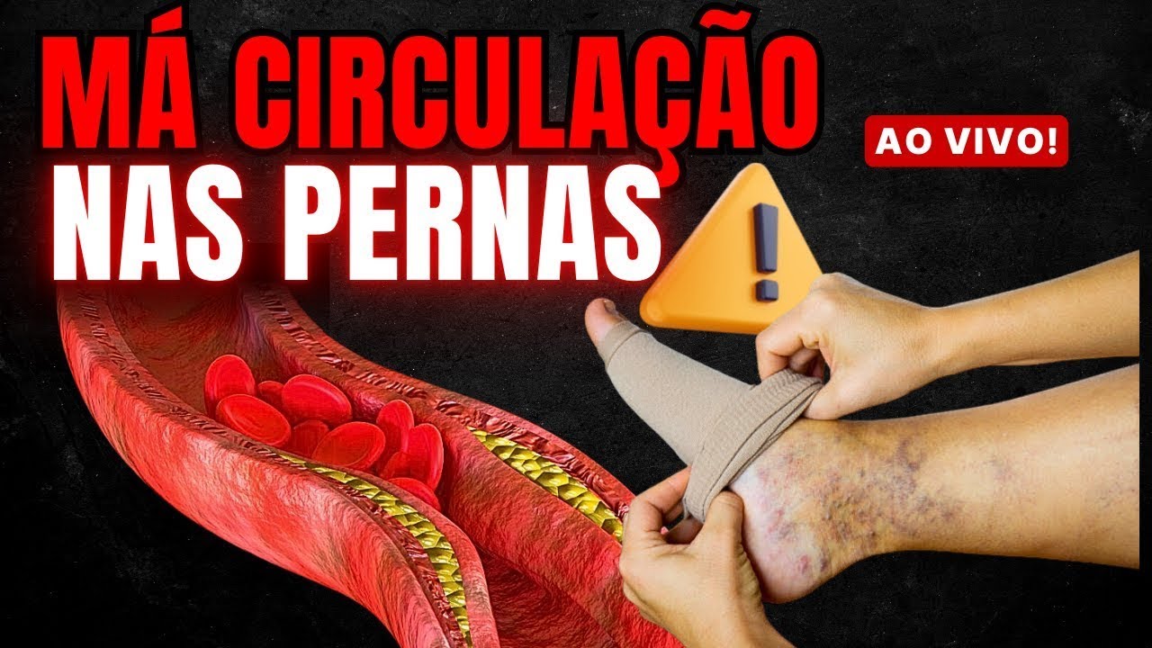 MÁ CIRCULAÇÃO nas PERNAS e PÉS ( secagem e aplicação das varizes, varicose e trombose ) - Dr. Alex