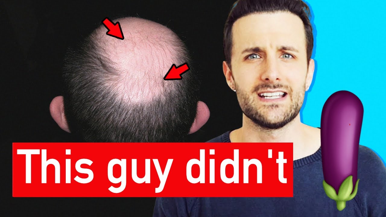 Does Norwood 7 Need Finasteride?