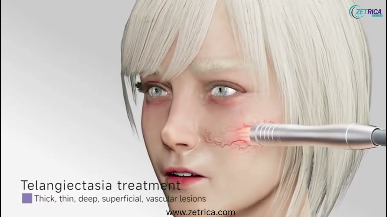 ZET DUALPULSE™ ENDO LASER 980nm / 1470nm Clinical Confidence in Every Pulse.