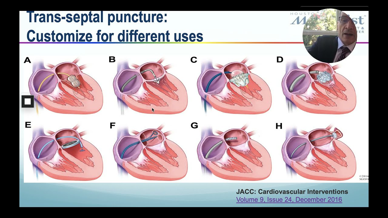 LAHRS2020 - 10NOV - ICE Guided Approach for LAA Closure