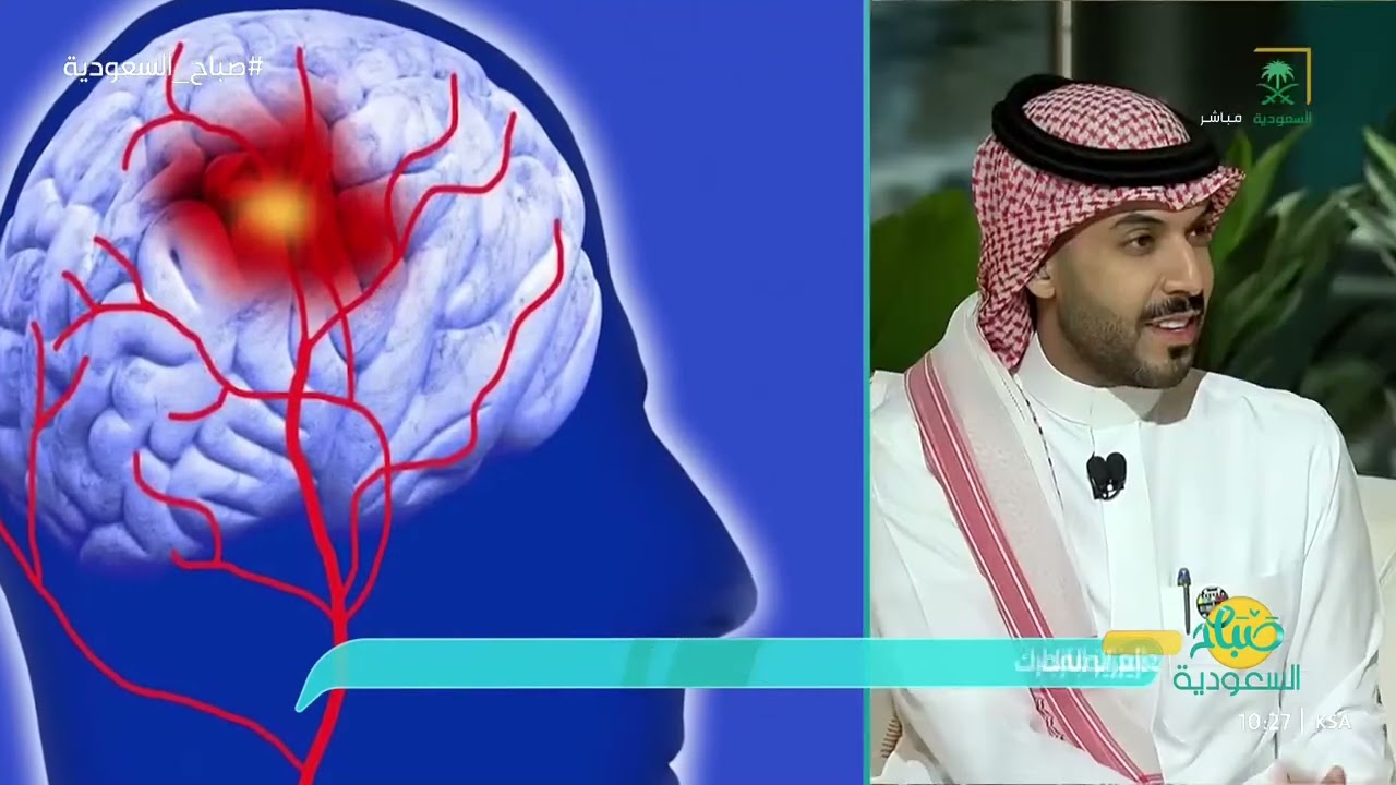 التشوّه الشرياني الوريدي في الدماغ، ما هي أسبابه وأعراضه وطرق علاجه؟