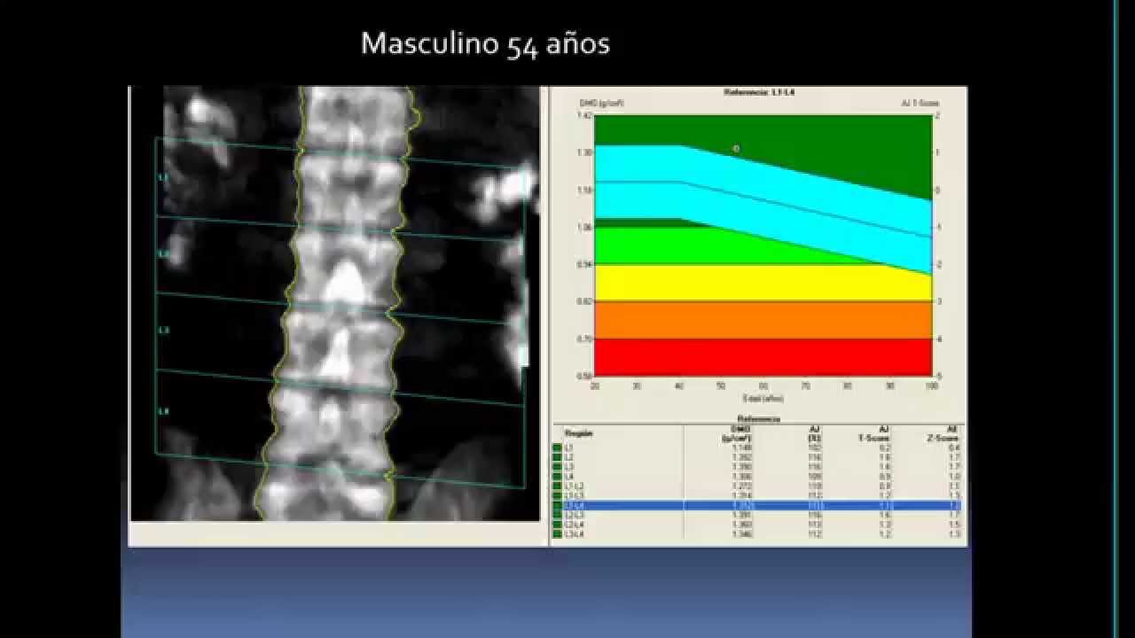 Utilidad clínica de los marcadores de remodelamiento óseo