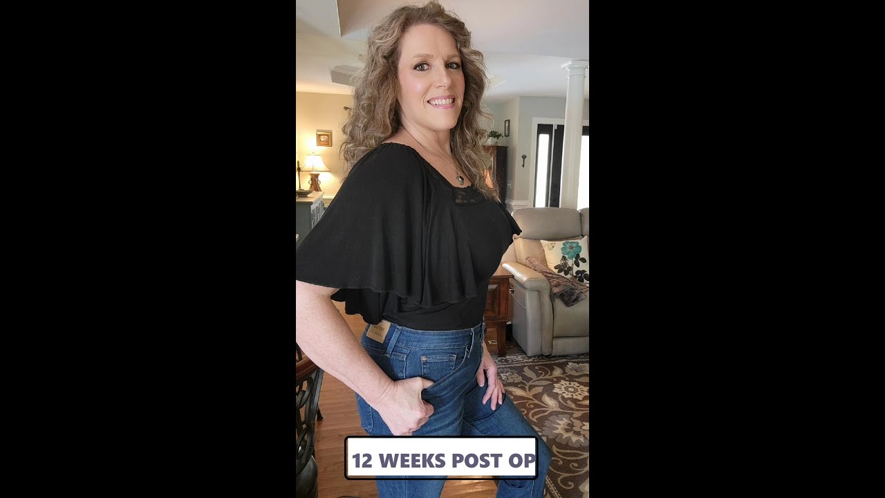 (838) TUMMY TUCK Abdominoplasty & Lipo Surgery REAL RESULTS Dr Brian Coan 12 Week Post Op Video 3