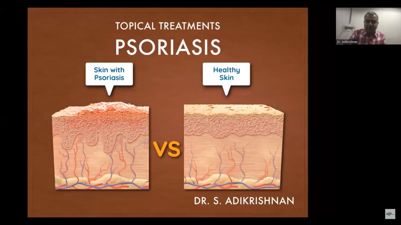 Topical & Systemic Treatment of Psoriasis