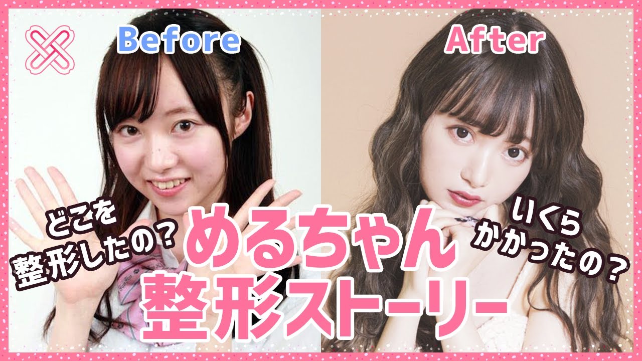 【整形】望月めるちゃんの整形ストーリー【もちめる】