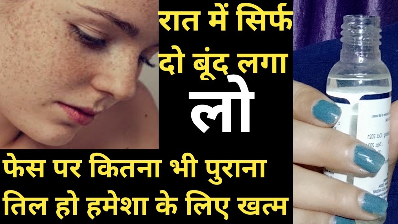 सिर्फ दो बूंद लगाने से मेरे फ्रेंड के फेस का सारा तिल खत्म हो गया 😱| Face Per Se Til Kaise Hataye