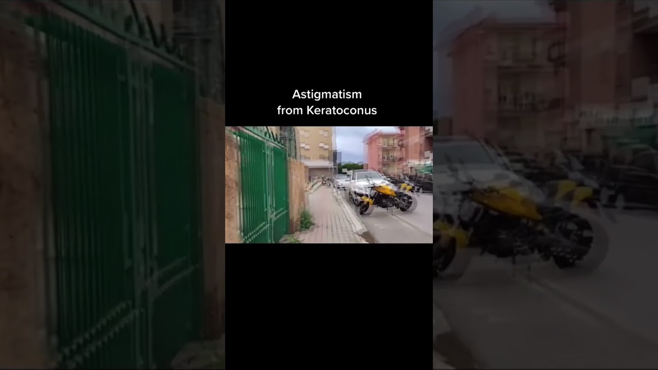 Моделирование зрения при кератоконусе #кератоконус #шорты Информация о лечении www.KeratoconusIns...