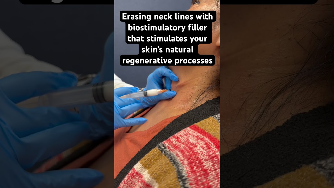 Erasing neck lines with Sculptra 