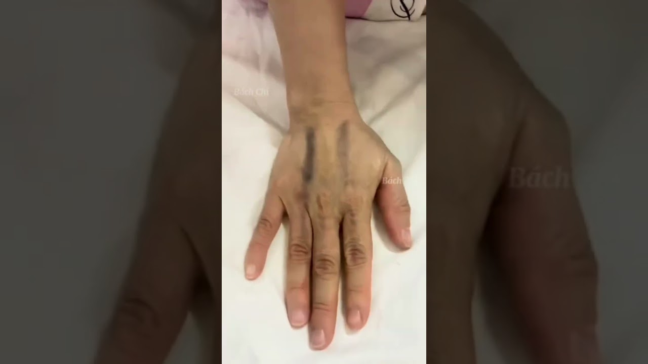 5 hiểu lầm về cạo gió mà bạn không ngờ tới