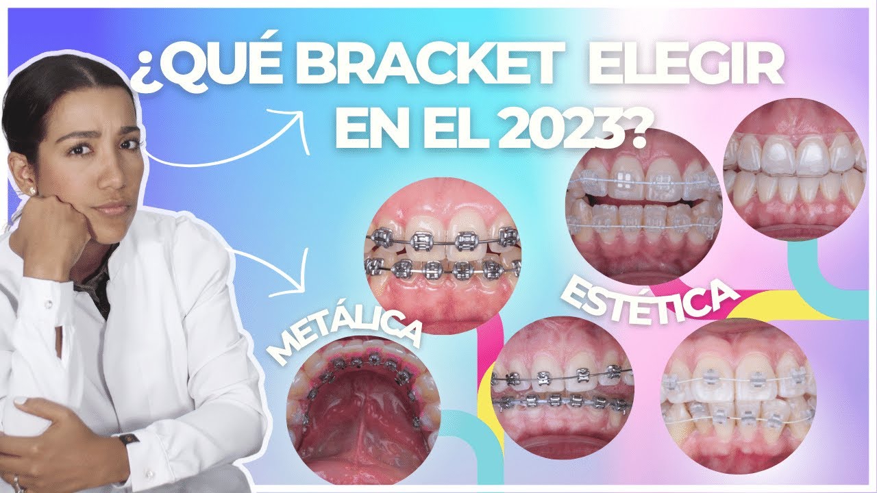 🦷VENTAJAS Y DESVENTAJAS DE ESTOS TIPOS DE ORTODONCIAS  I 🦷  2023 DRA. MINERVA FELIPE #dentalcare