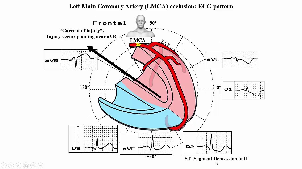 3° Modulo -  B) Identificación del vaso culpable por electrocardiograma