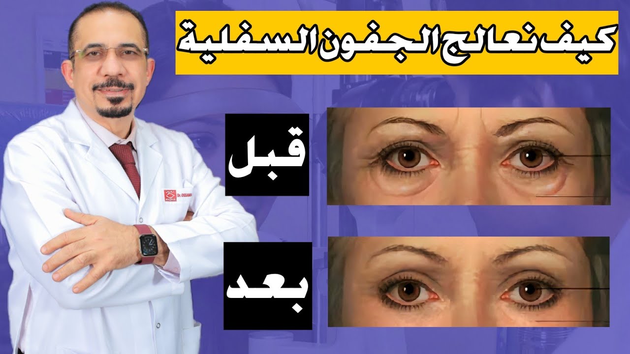 سر جمال العيون: علاج الجفون السفلية بطرق فعّالة! 🌟👁️