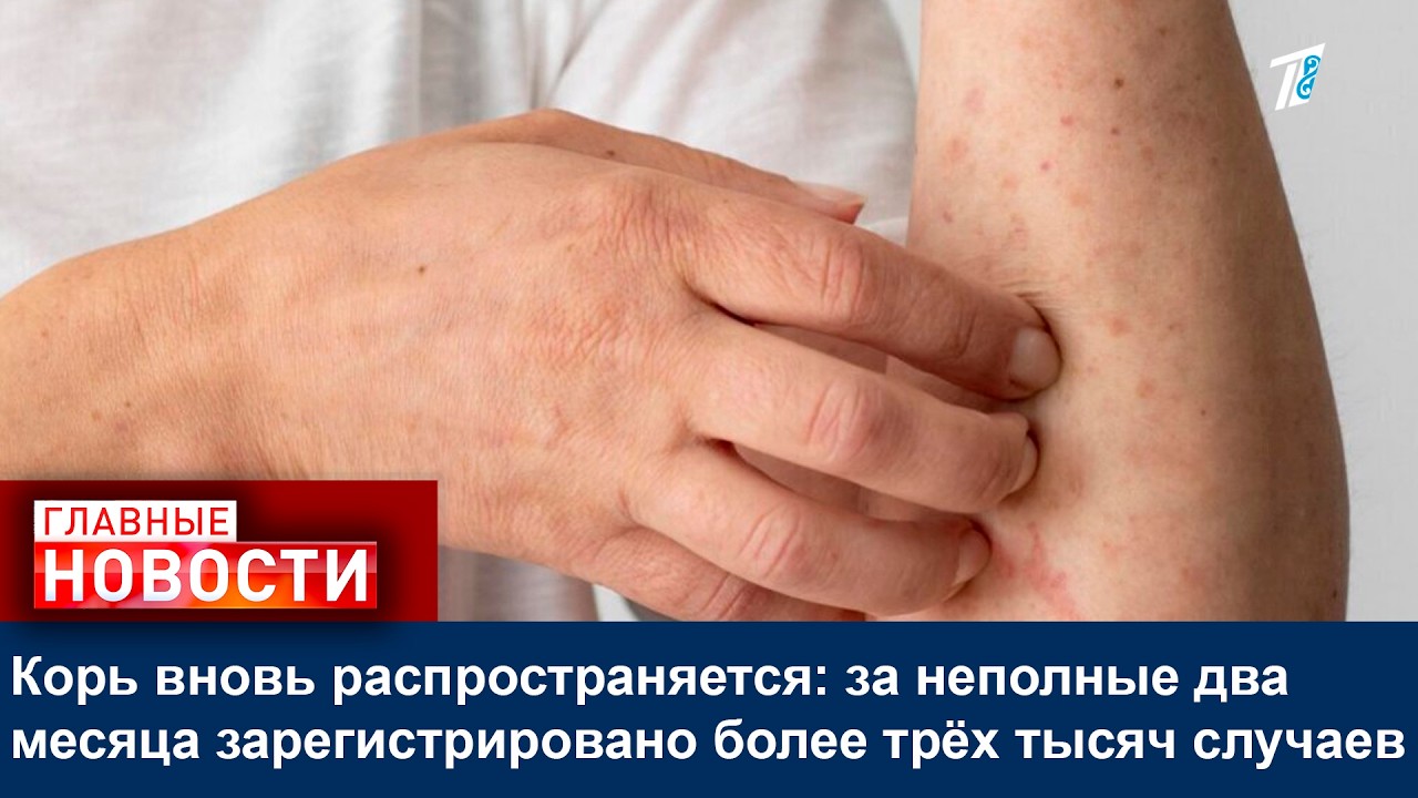 Корь вновь распространяется: за неполные два месяца зарегистрировано более трёх тысяч случаев