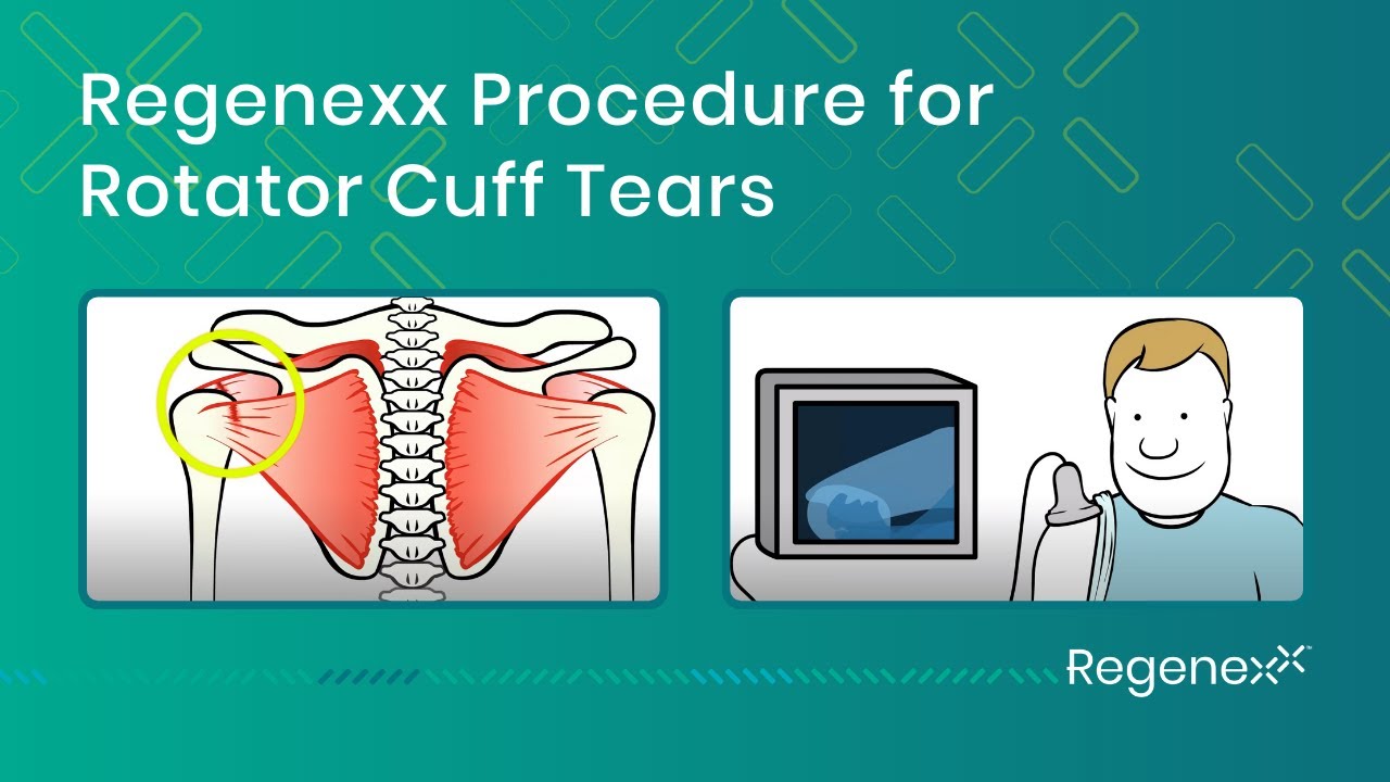 Regenexx Rotator Cuff - Orthopedic Regenerative Procedure for Rotator Cuff Tears