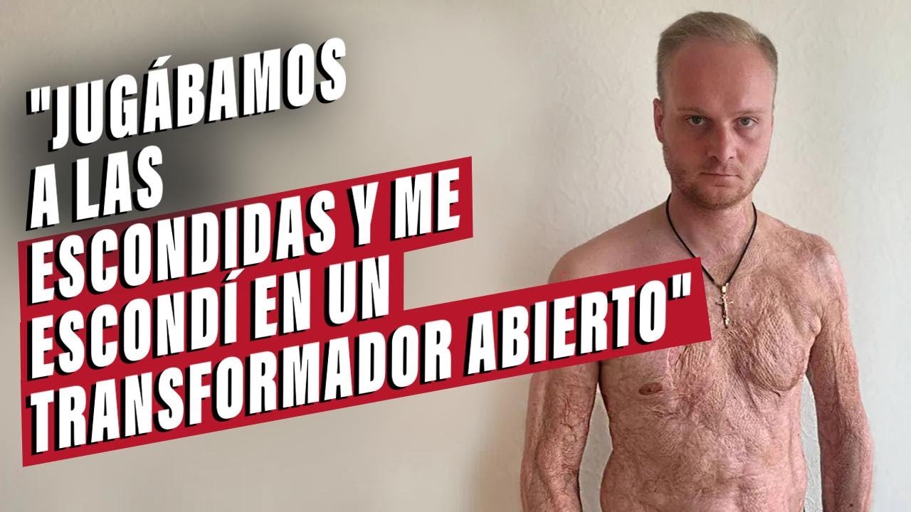 ¡Recibí una descarga de 10,000 voltios! La historia de Igor: Ser joven