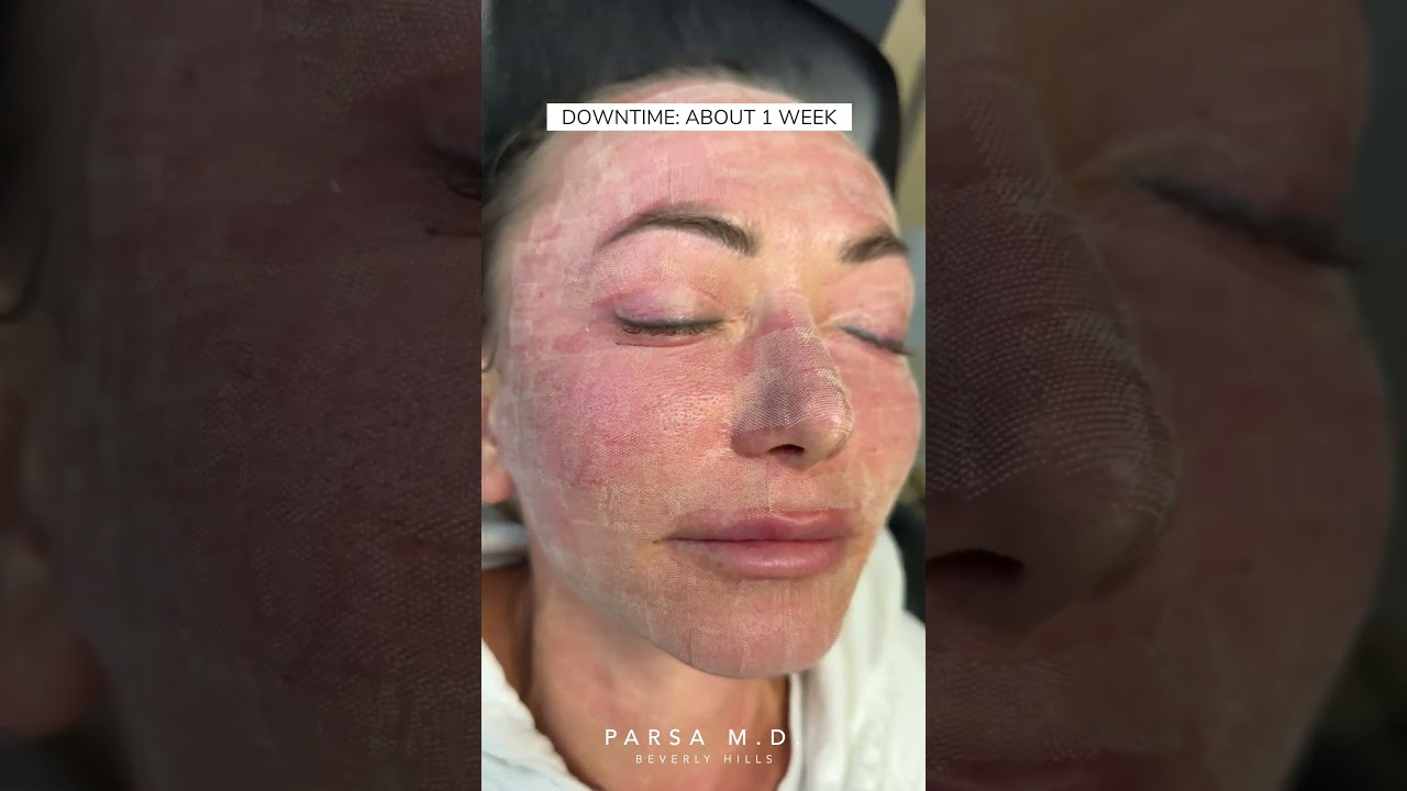Non-Surgical Skin Rejuvenation with Morpheus8 +Co2  Laser | Dr. Kami Parsa