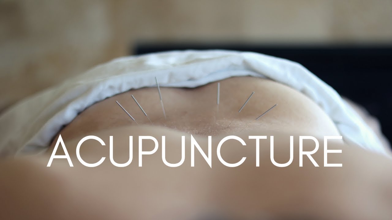 Acupuncture for low back pain | DOES IT HURT?