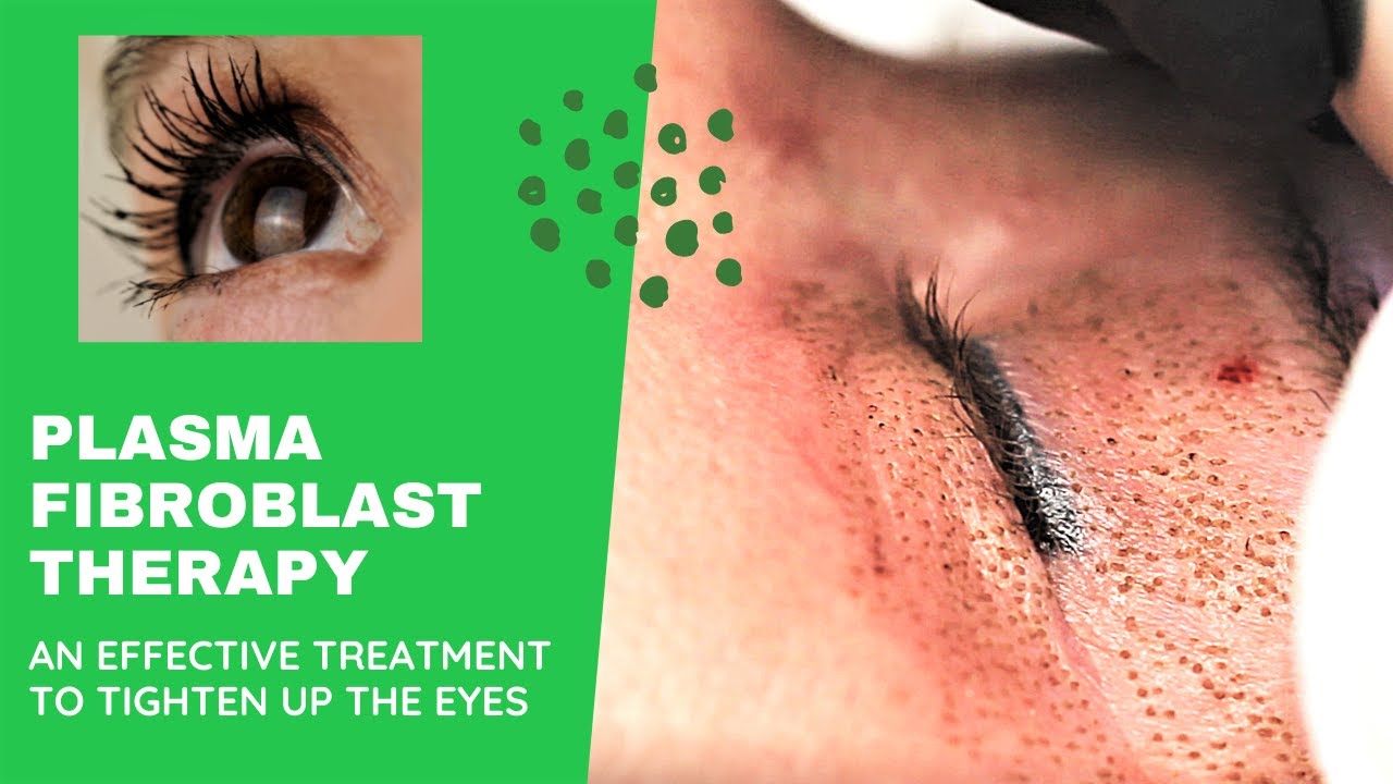 WHAT IS PLASMA FIBROBLAST THERAPY//BENEFITS OF PLASMA FIBROBLAST THERAPY//GOLD COAST SKIN TREATMENTS