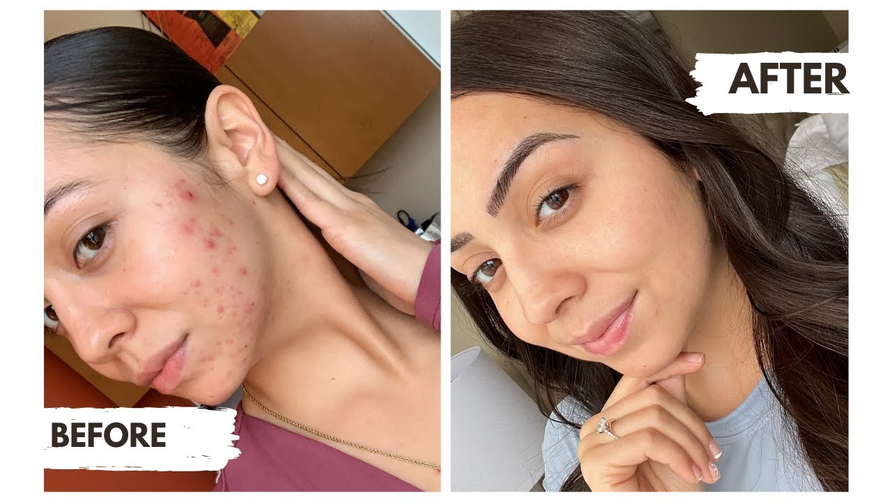 POST-ACCUTANE RESULTS | Current Skincare Routine | My Experience