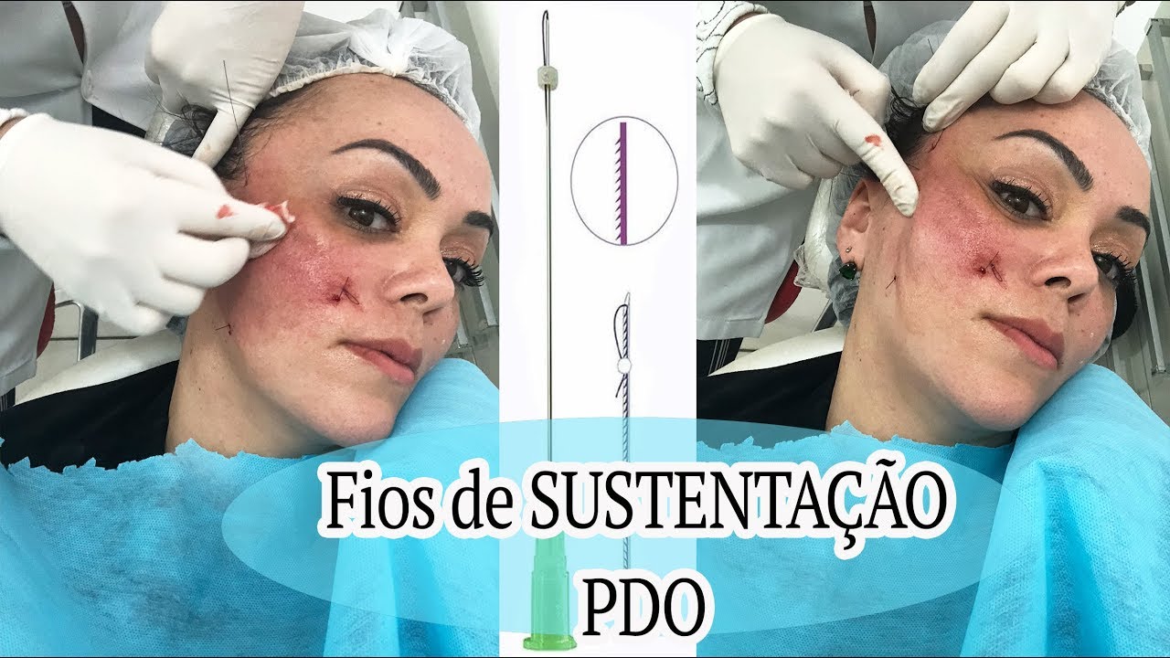 Fiz Fios de Sustentação no Rosto!