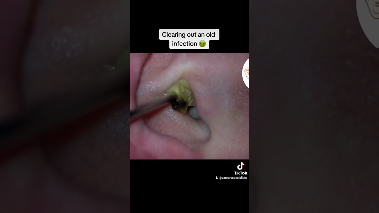 Old ear infection: debris and discharge removal #earcleaning #earcarespecialists #microsuction