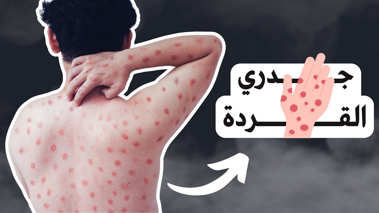 مرض جدري القردة | الحقائق الكاملة